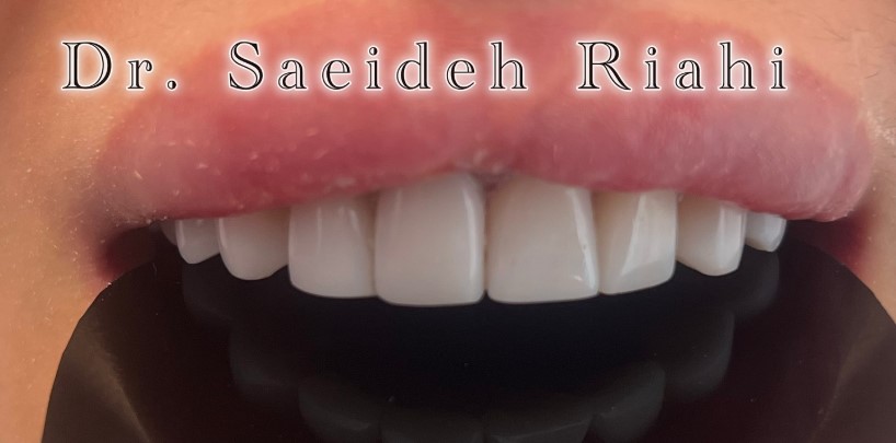 بعد از کامپوزیت دندان بیمار