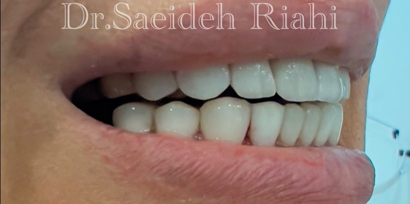  از لمینت دندان بیمار-2