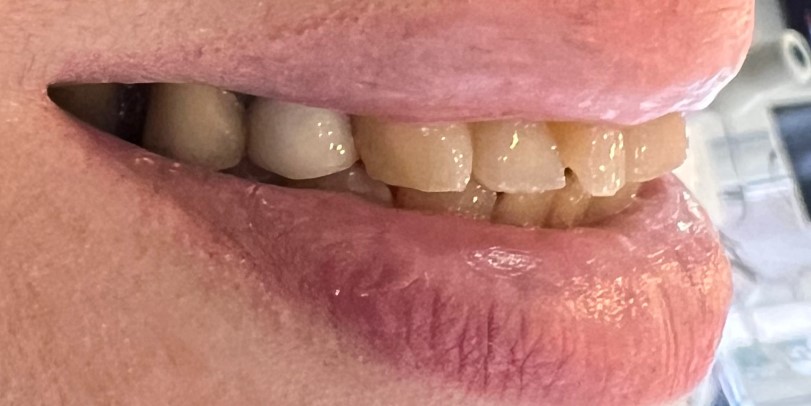  از لمینت دندان بیمار-2