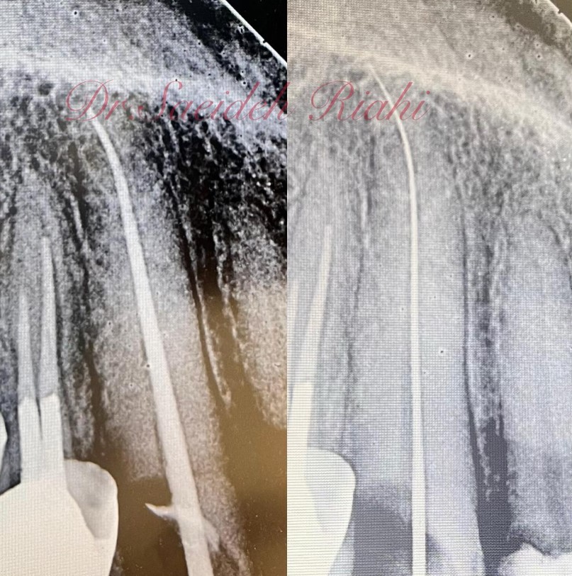 عصب کشی دندان