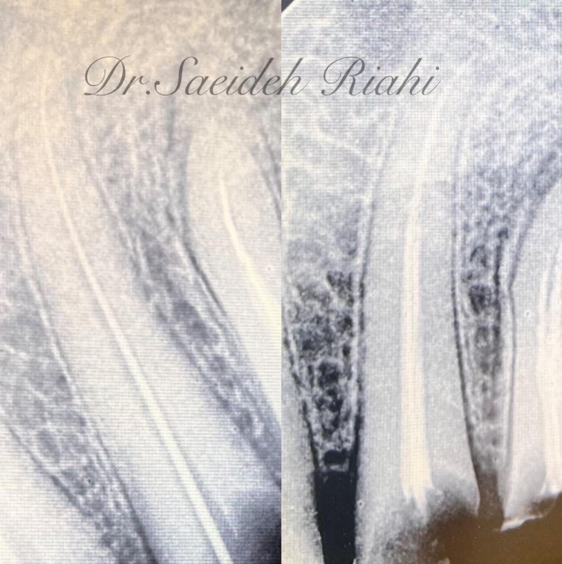 عصب کشی دندان