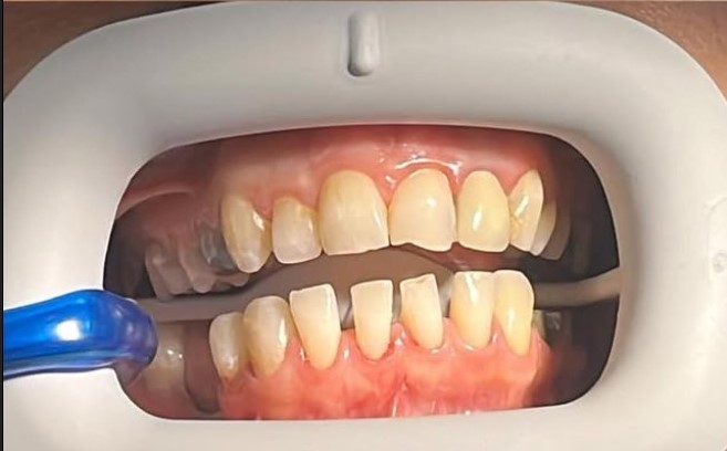 قبل بلیچینگ دندان بیمار