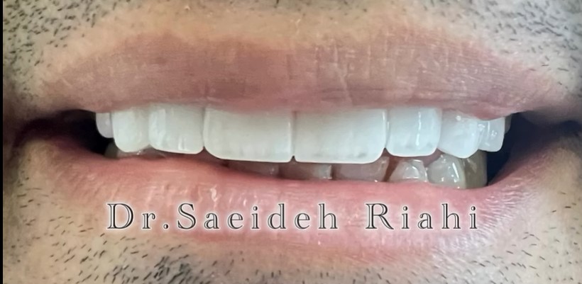 بعد از ایمپلنت دندان بیمار