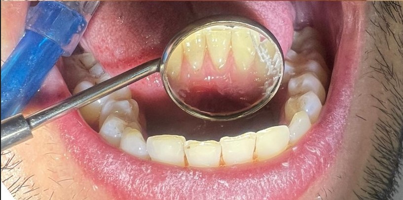 بعد از جرم‌گیری دندان بیمار