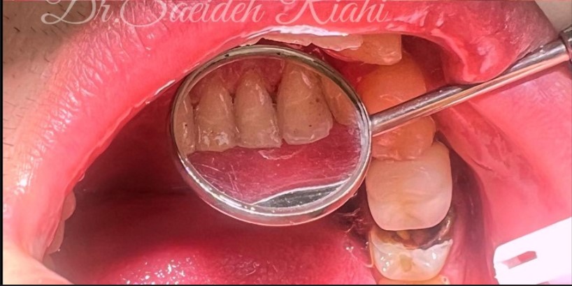 بعد از جرم‌گیری دندان بیمار