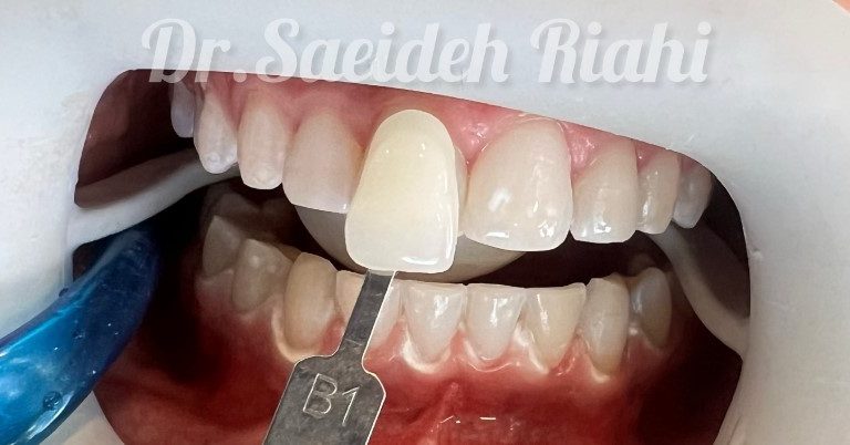 بعد بلیچینگ دندان بیمار