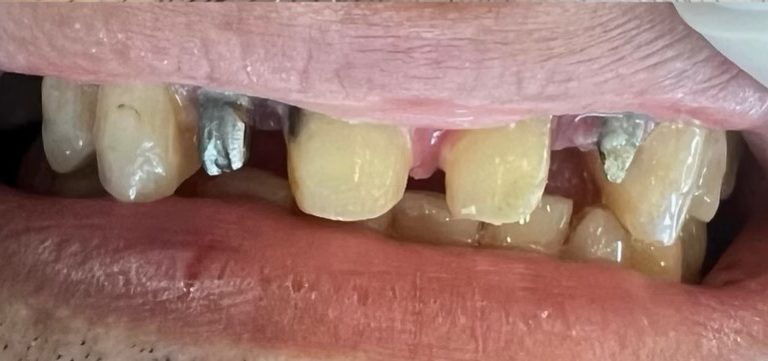 قبل از ایمپلنت دندان بیمار