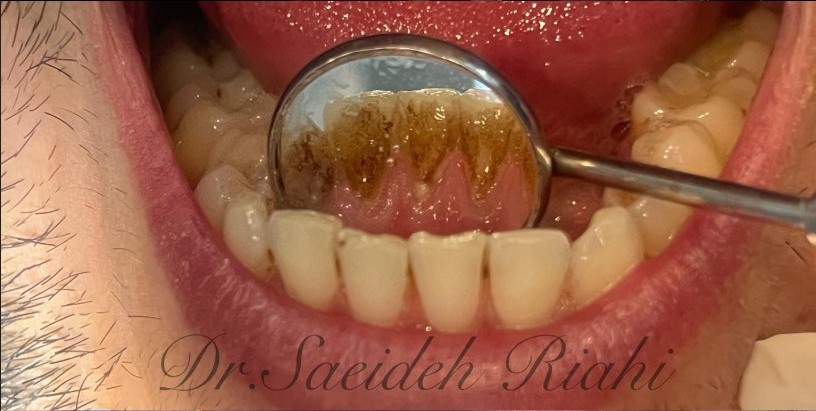 قبل از جرم‌گیری دندان بیمار