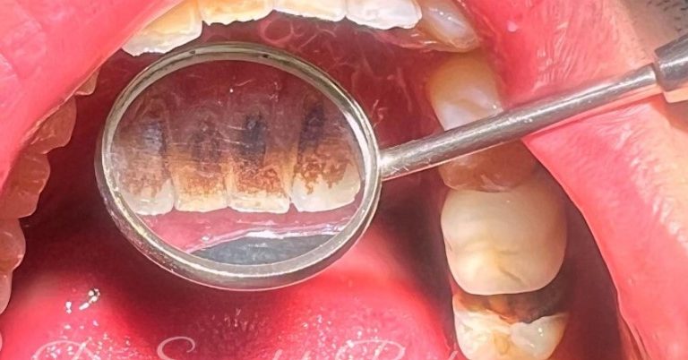 قبل از جرم‌گیری دندان بیمار