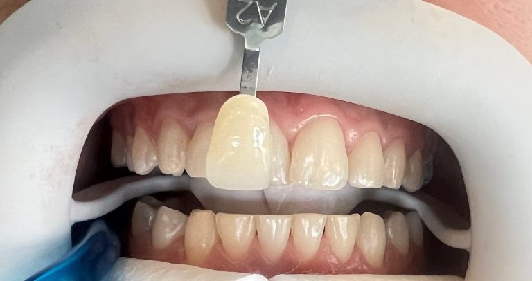 قبل بلیچینگ دندان بیمار