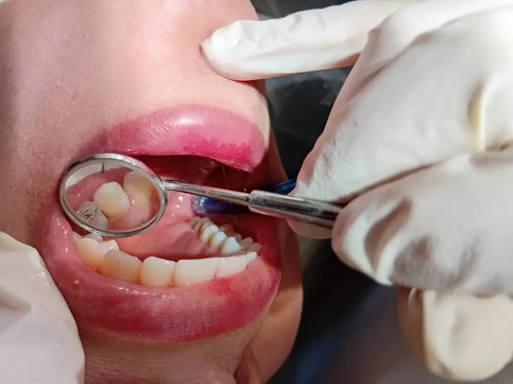 دندان ترمیم شده بیمار و رفع پوسیدگی