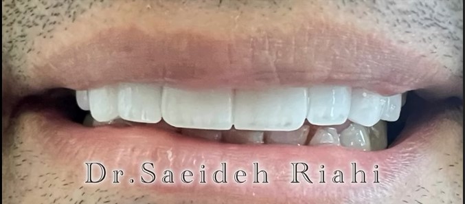 بعد از ایمپلنت دندان بیمار