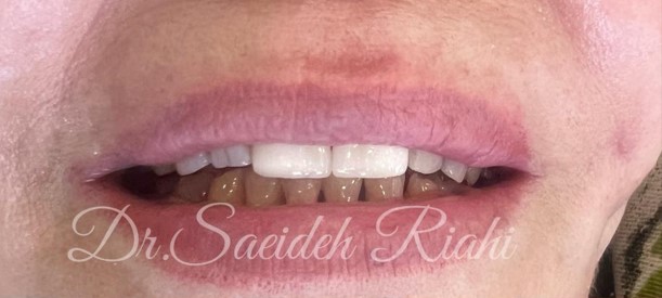  از روکش دندان بیمار-3