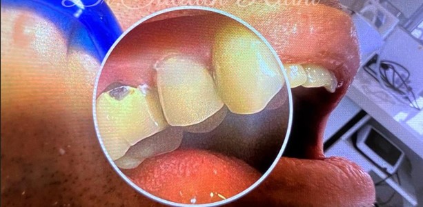  از روکش دندان بیمار-4