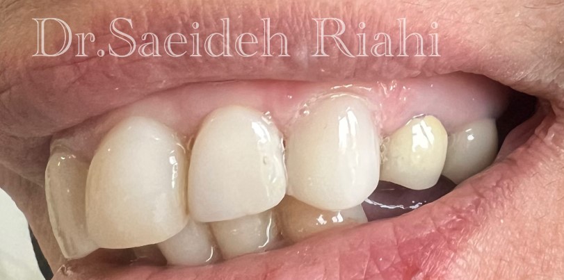  از کامپوزیت دندان بیمار-5