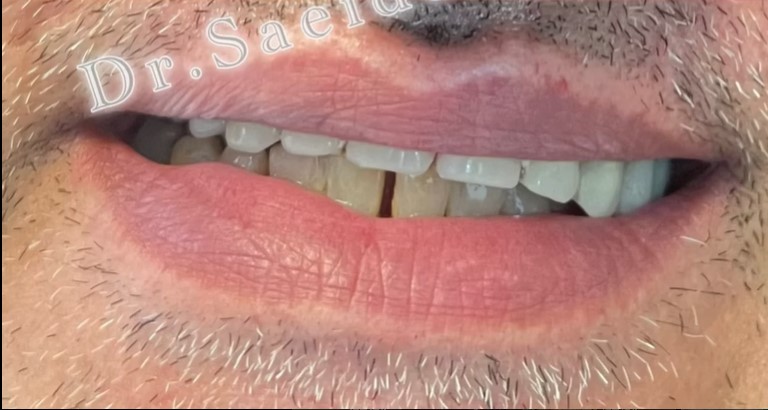  دندان مصنوعی بعد -1