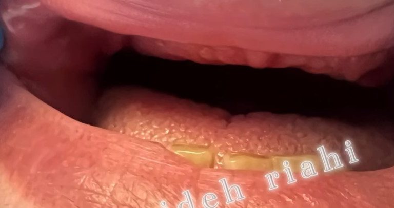  دندان مصنوعی قبل -1