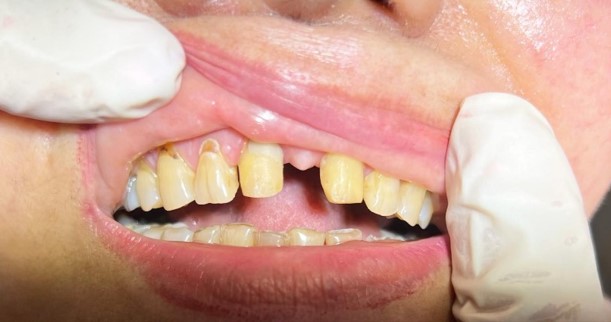  از روکش دندان بیمار-3