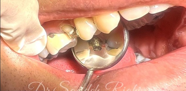  از روکش دندان بیمار-4