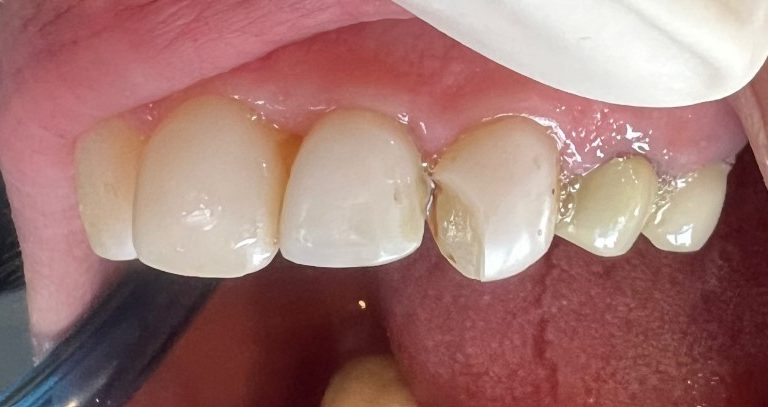  از کامپوزیت دندان بیمار-5