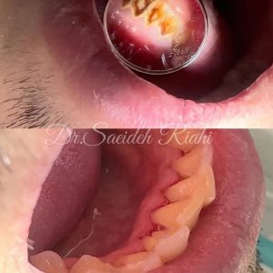 تصویر قبل و بعد از جرم‌گیری و بروساژ دندان بیمار