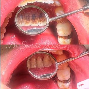 تصویر قبل و بعد از جرم‌گیری و بروساژ دندان بیمار
