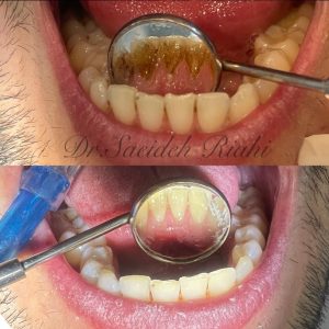 تصویر قبل و بعد از جرم‌گیری و بروساژ دندان بیمار