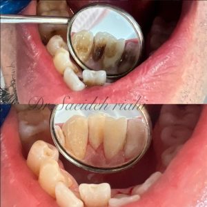 تصویر قبل و بعد از جرم‌گیری و بروساژ دندان بیمار