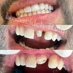 تصویر قبل و بعد از روکش دندان بیمار