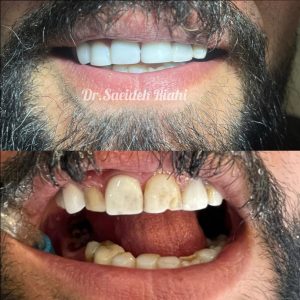 تصویر قبل و بعد از روکش دندان بیمار
