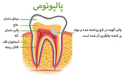 تصویر توضیحاتی پالپوتومی در دندان‌های شیری کودکان