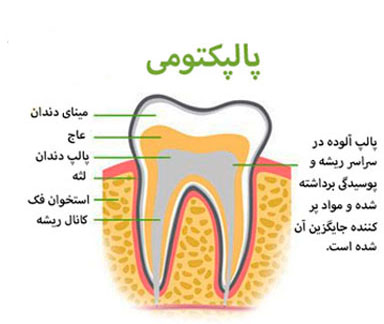 تصویر توضیحی پالپکتومی (Pulpectomy) در اطفال